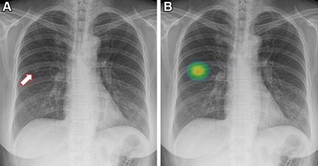 AI Boosts Lung Cancer Detection Sensitivity by 24% Without Increasing False Positives